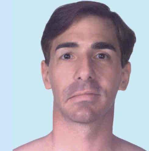 <ul><li><p>Injury to the facial nerve (CN VII) or its branches produces paralysis of some or all facial muscles on the affected side</p></li><li><p>The affected area sags, and facial expression is distorted, making it appear passive or sad</p></li></ul>