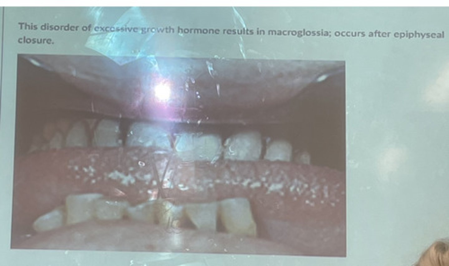 <p>This disorder of excessive growth hormone results in macroglossia; occurs after epiphyseal closure</p>