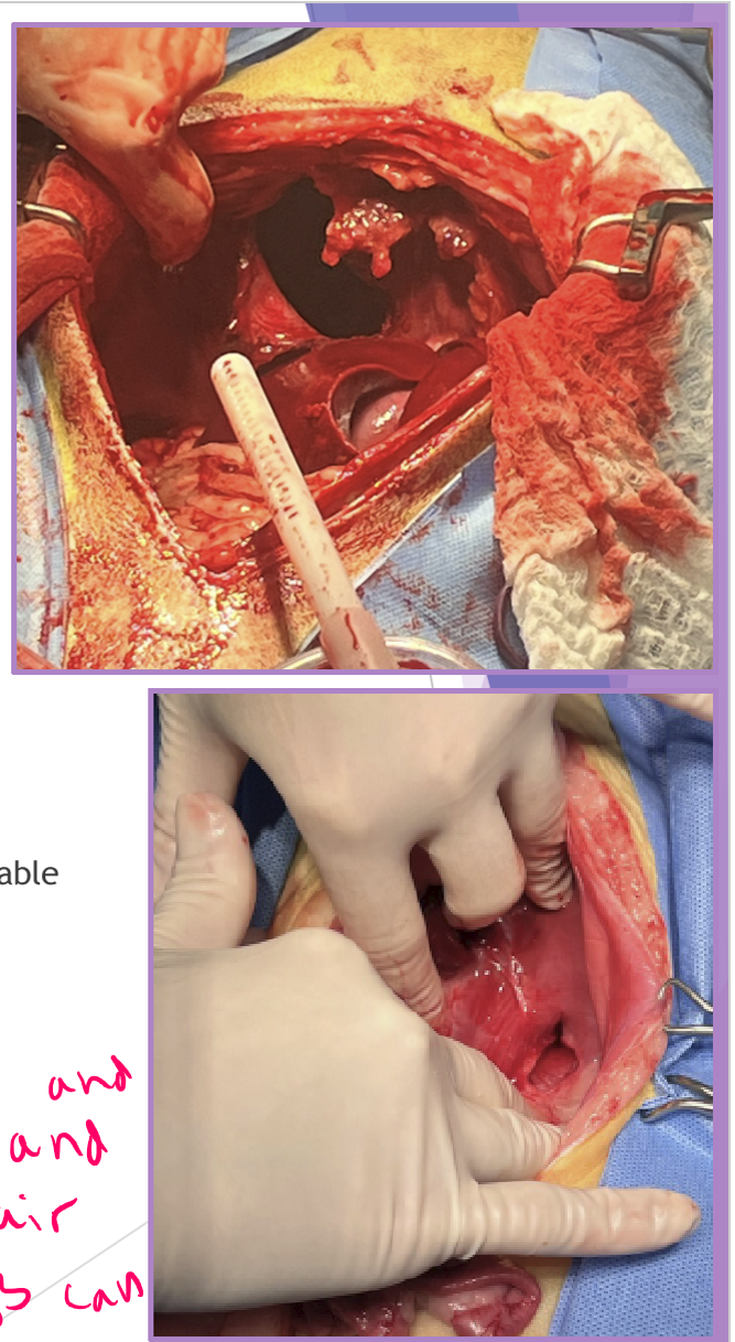 <ul><li><p>Surgical repair - be prepared for anything! </p><ul><li><p>abdominal exploratory </p></li><li><p>identify hernia and <strong>carefully </strong>reduce contents </p><ul><li><p>caution - adhesions could be present </p></li></ul></li><li><p>close diaphragmatic defect </p><ul><li><p>account for tension </p></li><li><p><strong>freshen edges if chronic </strong></p></li><li><p>suture defect closed - simple continuous with absorbable suture </p><ul><li><p>3-0 PDS</p></li><li><p><strong>suture from dorsal (deep) to ventral (superficial) </strong></p></li></ul></li></ul></li><li><p>remove air from thoracic cavity - with needle and syringe and pull air out so lungs can re-expand </p></li><li><p>do NOT re-expand lungs manually!!!</p><ul><li><p>can cause re-expansion pulmonary edema </p></li></ul></li></ul></li></ul><p></p>