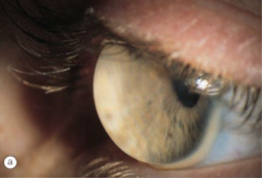 <ul><li><p><span><strong>Onset</strong>: birth or adulthood</span></p><ul><li><p><span><u>Presentation at birth</u> is associated with Ehler-Danlos, Leber congenital amaurosis &amp; blue sclera</span></p></li><li><p><span><u>Presentation in adulthood</u> is thought to evolve from keratoconus or pellucid marginal degeneration</span></p></li></ul></li><li><p><span><strong>Symptoms</strong>: decreased visual acuity</span></p></li><li><p><span><strong>Presentation</strong>:</span></p><ul><li><p><span><u>Refractive error findings</u>: myopia and irregular astigmatism</span></p></li><li><p><span><u>Slit lamp findings</u>: globular cornea with <em>generalized</em> corneal thinning</span></p><ul><li><p>hydrops are rare</p></li><li><p>corneal diameter is <em>normal</em></p></li></ul></li><li><p><span><u>Corneal topography</u>: steepening limbus to limbus</span></p></li></ul></li><li><p><span><strong>Complications</strong>: corneal rupture with relatively mild trauma</span></p></li><li><p><span><strong>Treatment</strong>:</span></p><ul><li><p>spectacles</p></li><li><p>scleral contact lenses</p></li><li><p>lamellar keratoplasty</p></li></ul></li></ul><p></p>
