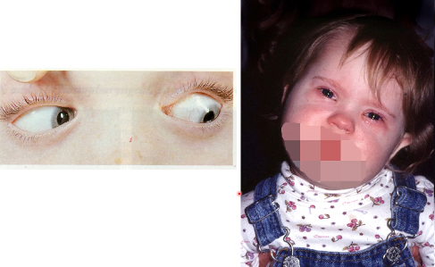 <p>tilting head to contralateral side, diplopia in affected eye, cannot depress eye fully when adducted</p>