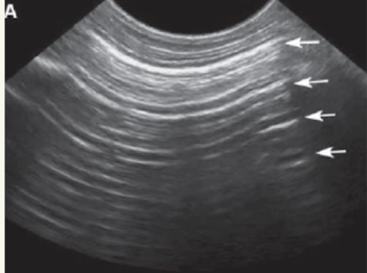 <p>las líneas hiperecoícas y horizontales, de reverberación, creado por el aire en el pulmón. (son normales)</p>