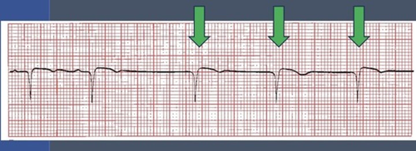 <p>What is an escape beat?</p>
