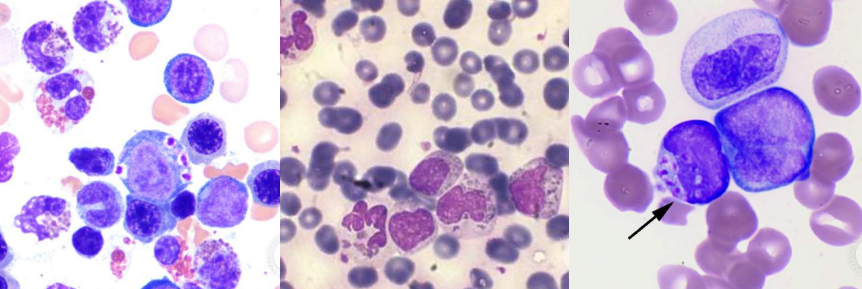 <p>A. Identify the abnormality / cell</p><p>B. This is seen in what condition / disease</p>