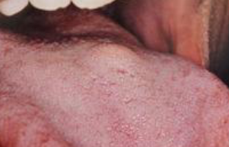 <p>benign pink/yellow mass with granular surface, pseudoepitheliomatous may be mistaken for SCC</p>