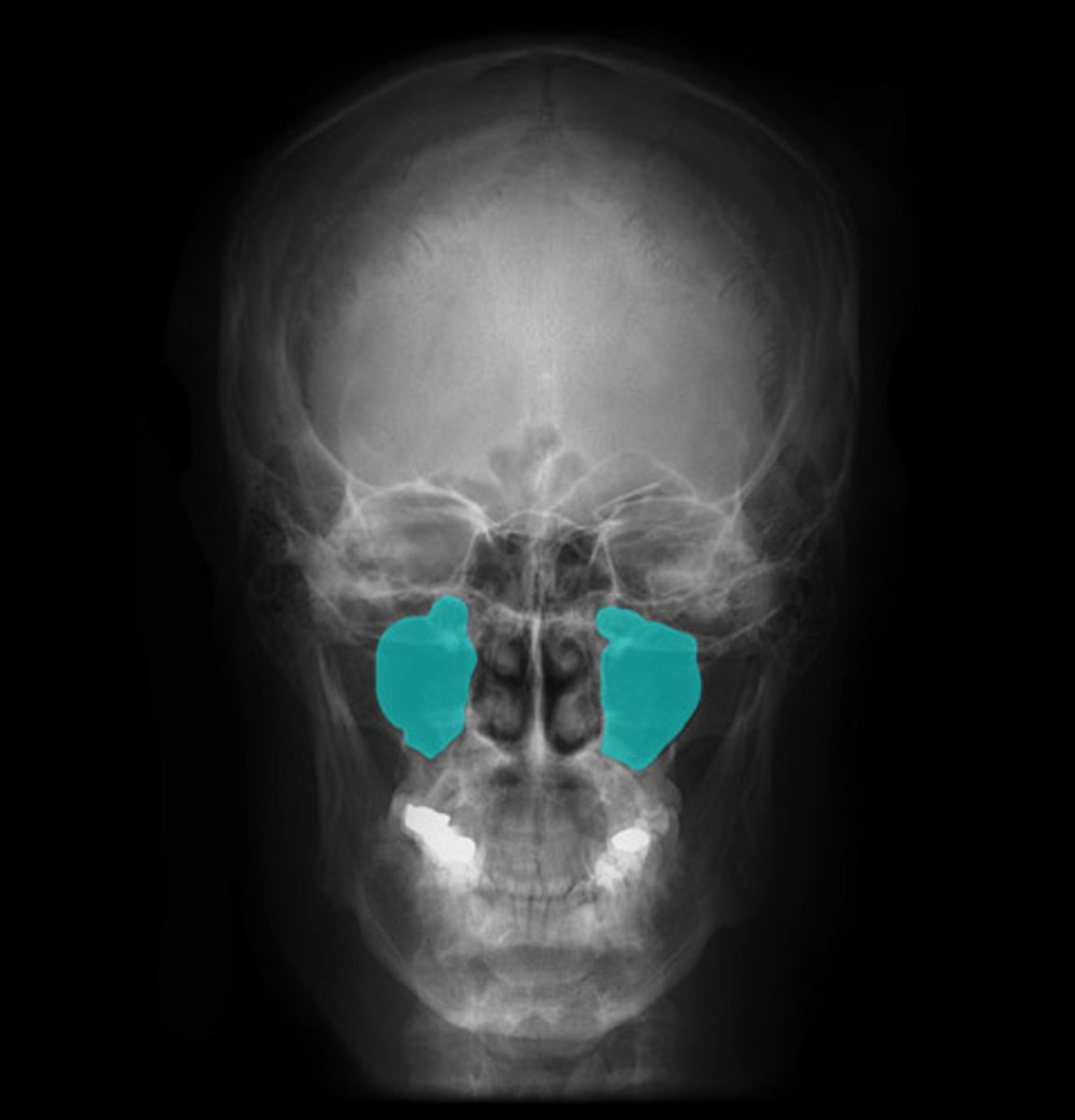 <p>Radiolucent space above posterior maxillary teeth</p>