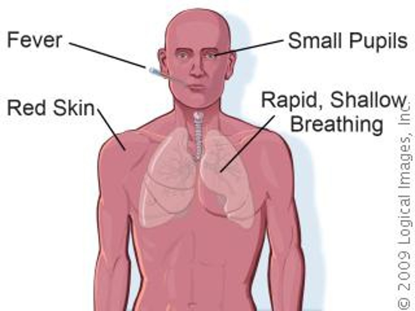 <p>hot, dry skin; higher than normal body temperature; rapid pulse; rapid, shallow breathing; could lose consciousness</p>