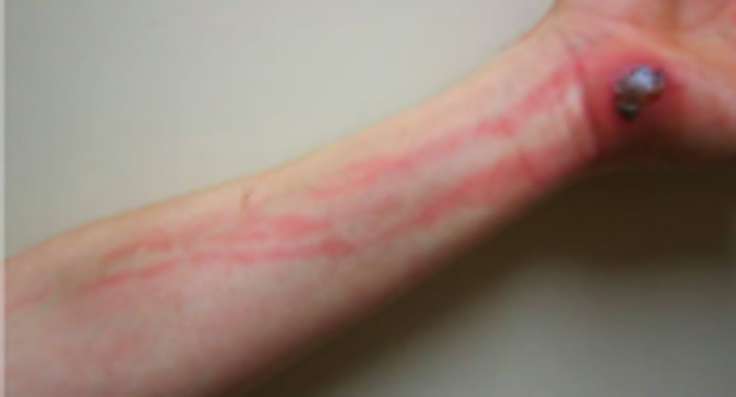 <p>Bacterial ID:</p><p>Overview:</p><p>- Manifests as skin erythema, edema, and warmth</p><p>- Results of bacterial entry via breaches in skin barrier</p><p>- Observed in middle-aged and older adults; seasonal predilection for warmer months</p><p>Most commonly:</p><p>Group A streptococcus (strep is most common bacteria causing rashes), Streptococcus pyogenes</p><p>Risk factors:</p><p>- Skin barrier disruption due to trauma</p><p>- Skin inflammation (eczema, radiation therapy, psoriasis)</p><p>- Edema, Obesity, Immunosuppression</p><p>- Skin breaks between toes</p><p>- Preexisting skin infection (tinea pedis, impetigo, varicella)</p>