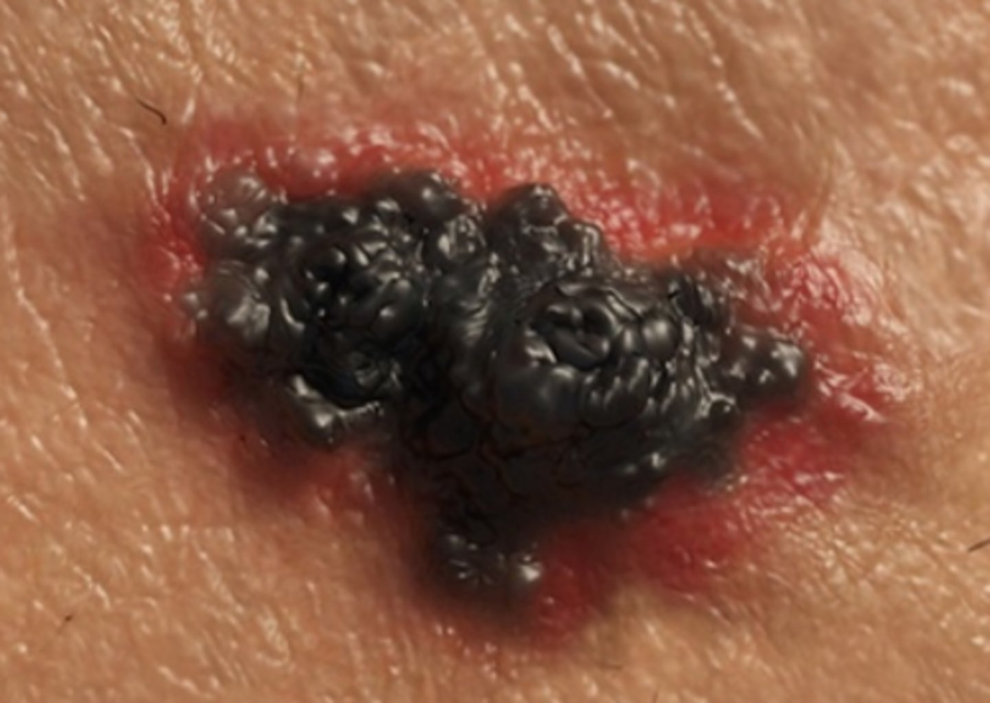 <p>Most deadly skin cancer</p><p>Develops in melanocytes</p>