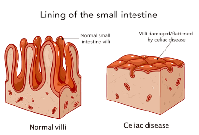 <p>Diferente a la intolerancia!</p><p>Es una enfermedad autoinmune a la que se está genéticamente predispuesto: el sistema inmune reconoce al gluten como algo nocivo y lo ataca</p><p>Respuesta inflamatoria: el epitelio pierde las vilis, por lo que habrá problemas de absorción</p>