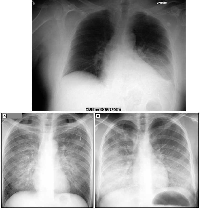 <ul><li><p>lobar consolidations</p></li><li><p>interstitial infiltrates</p></li><li><p>cavitations</p></li></ul><p></p>