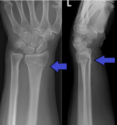 <p>When the fracture does not extend into the joint, this is <em>_____</em></p>