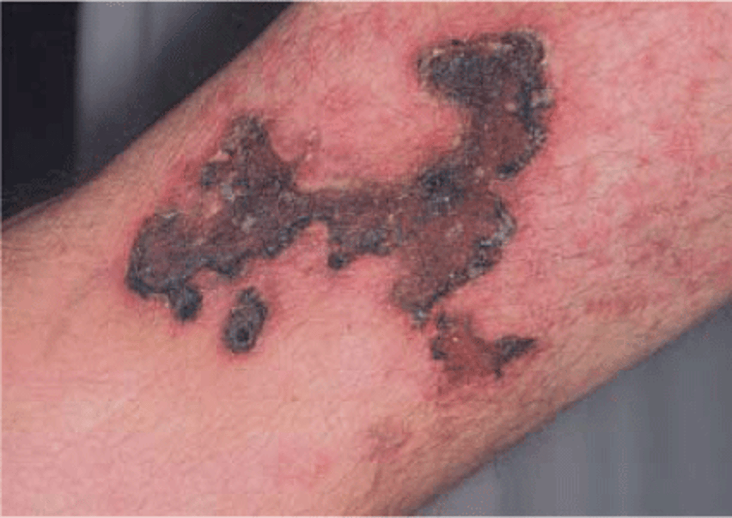 <p>Painful cutaneous lesions due to tissue ischemia and infarct</p><p>Can lead to ulcers and infection</p>