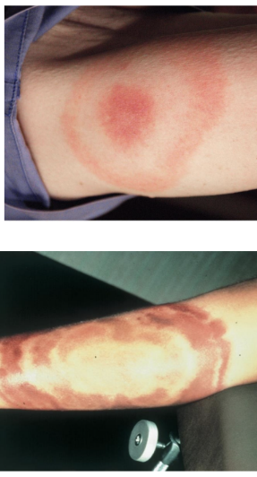 <p><strong>Causative agent:</strong> <em>Borrelia burgdorferi</em></p><p><strong>Reservoir</strong>: Deer, small mammals.</p><p><strong>Vector</strong>: Ticks</p><p><strong>First symptom:</strong> Bull's-eye rash</p><p><strong>Second phase:</strong> Irregular heartbeat, encephalitis</p><p><strong>Third phase:</strong> Arthritis</p><p></p>