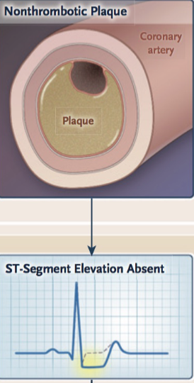 ST depression &/or T wave inversion in the affected leads.
ST segment elevaton is absent
