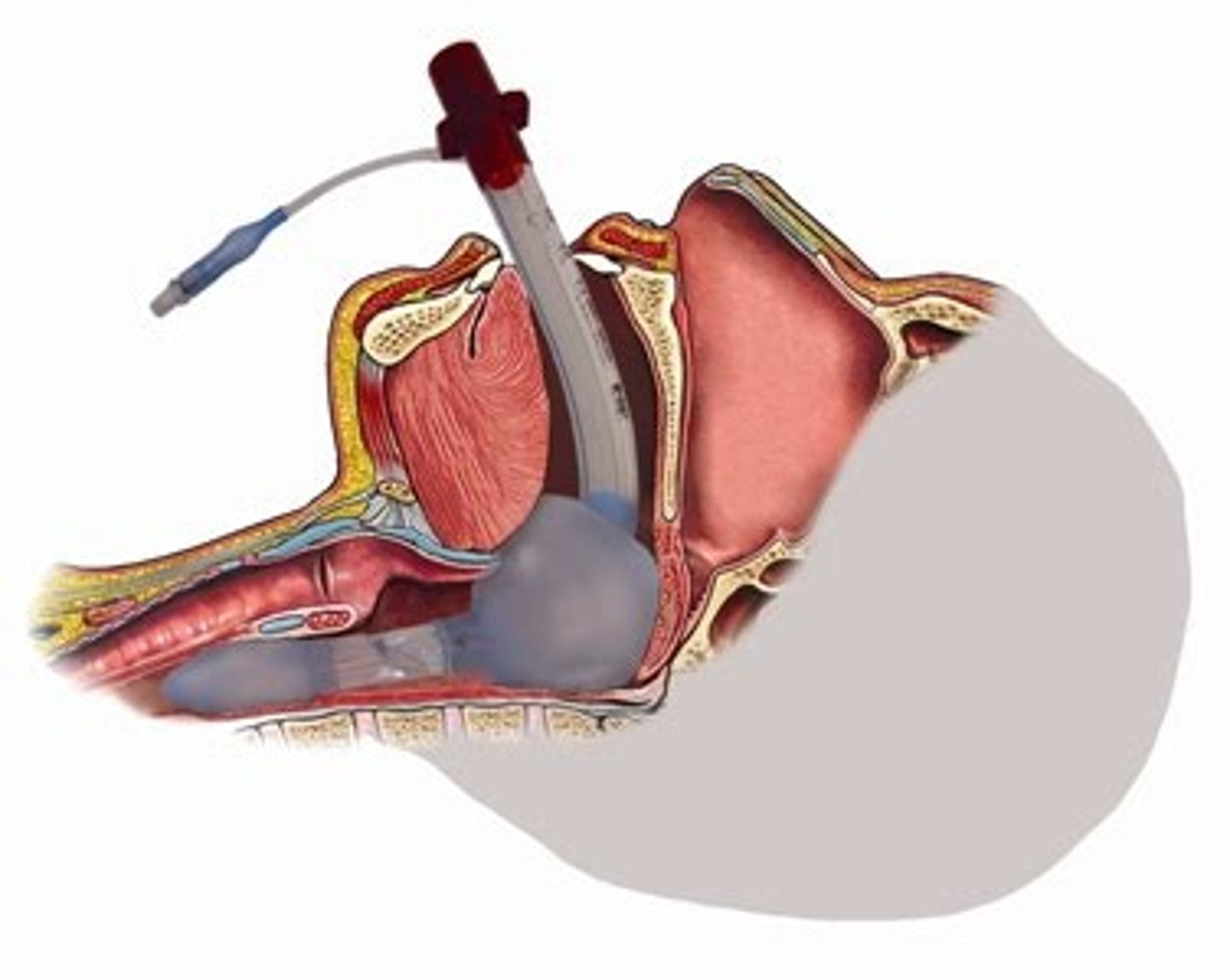 <p>Supraglottic airway device that uses two seals that creates a patent seal at the esophagus and pharynx</p>