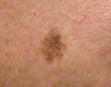 <p>Hoe heet dit klinisch beeld?</p>