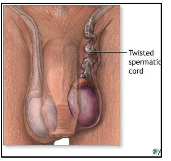 <ul><li><p>a urologic surgical emergency</p></li><li><p>very painful condition</p></li><li><p>delay in diagnosis and treatment can lead to infarction and loss of the testicle</p></li><li><p>requires surgery, time is key factor for preservation of testicle:</p><ul><li><p>&lt;6 hrs -90%</p></li><li><p>12 hrs - 50%</p></li><li><p>24 hrs - 10%</p></li><li><p>&gt;24 hrs - 0%</p></li></ul></li></ul><p></p>