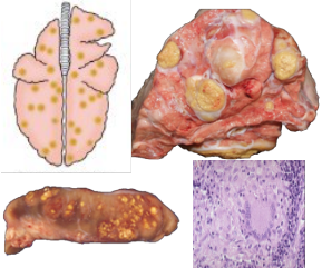 <p>What pattern of lung pathology? Describe appearance and pathogenesis. 3 example causes.</p>