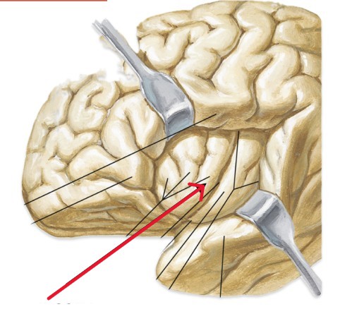 <p>Which part of the brain is:</p><ul><li><p>Deep to temporal lobe</p></li><li><p>Inside the brain</p></li></ul><p></p>