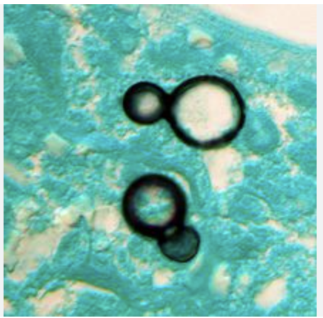 <p>Diagnosis for Blastomycosis</p>