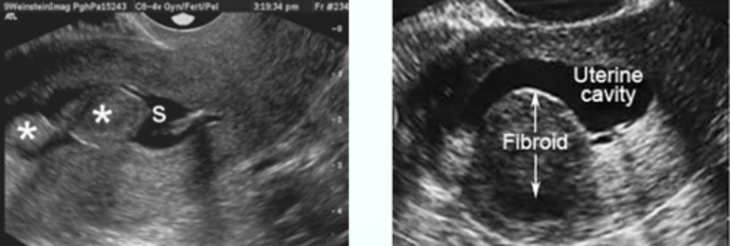 <p>Sonohysterography (saline infusion ultrasound)</p>