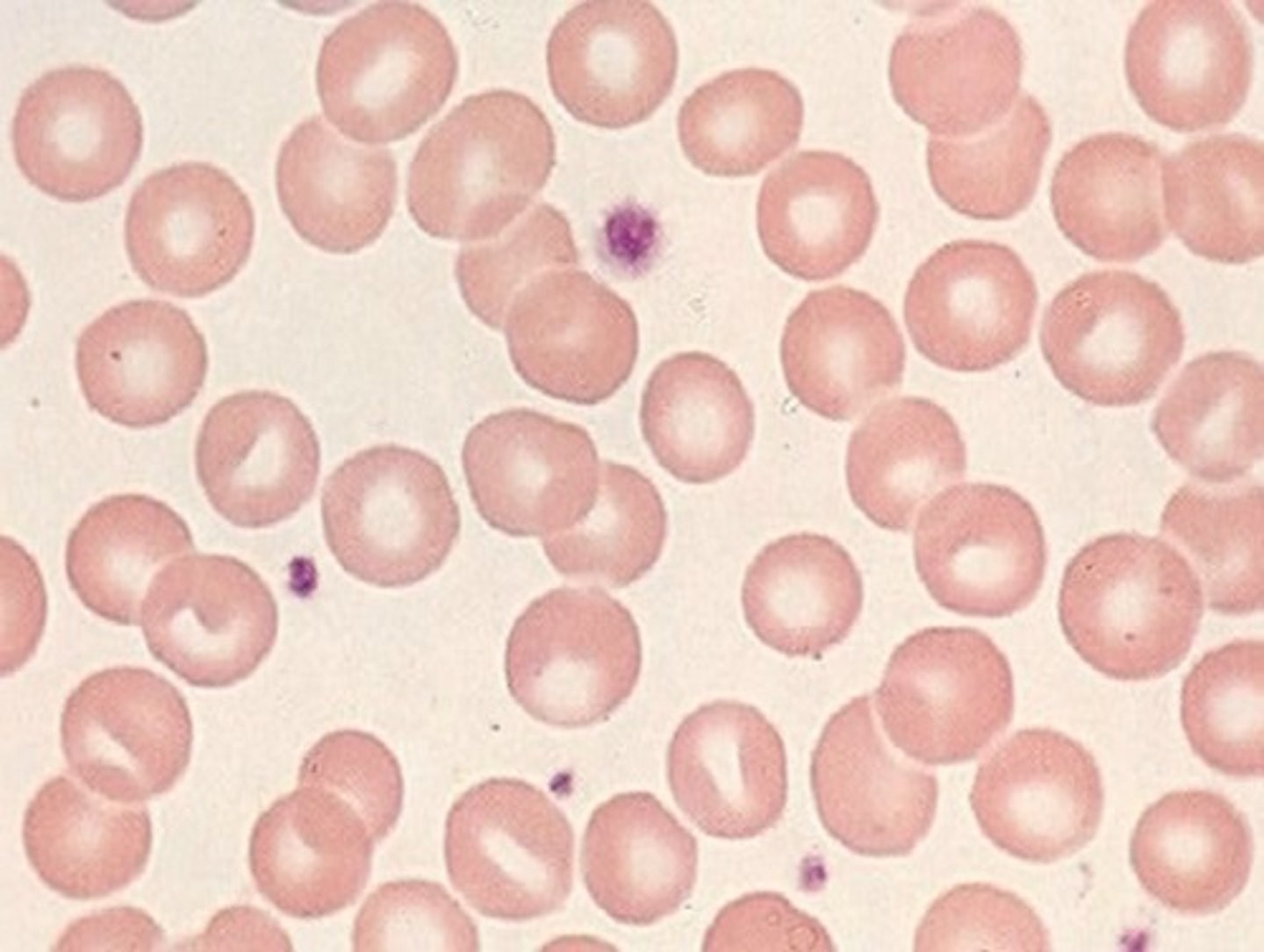 <p>if increased reticulocytes then the body is recovering from something: acute hemorrhage, hemolytic anemia, etc<br><br>if decreased or normal reticulocyte count then body is not responding properly and greater problem: Renal insufficency or failure, BM cancer, combined anemias, etc</p>