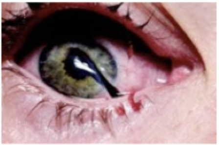<p>Patient presents to the ER after being stabbed by his ex-wife with an ice pick. On a physical exam you note markedly decreases visual acuity and an eccentric pupil. The IOP is low with decrease anterior chamber depth and there is an extrusion of vitreous humor and external prolapse of internal ocular structures. What are we not going to do on this patient?</p>