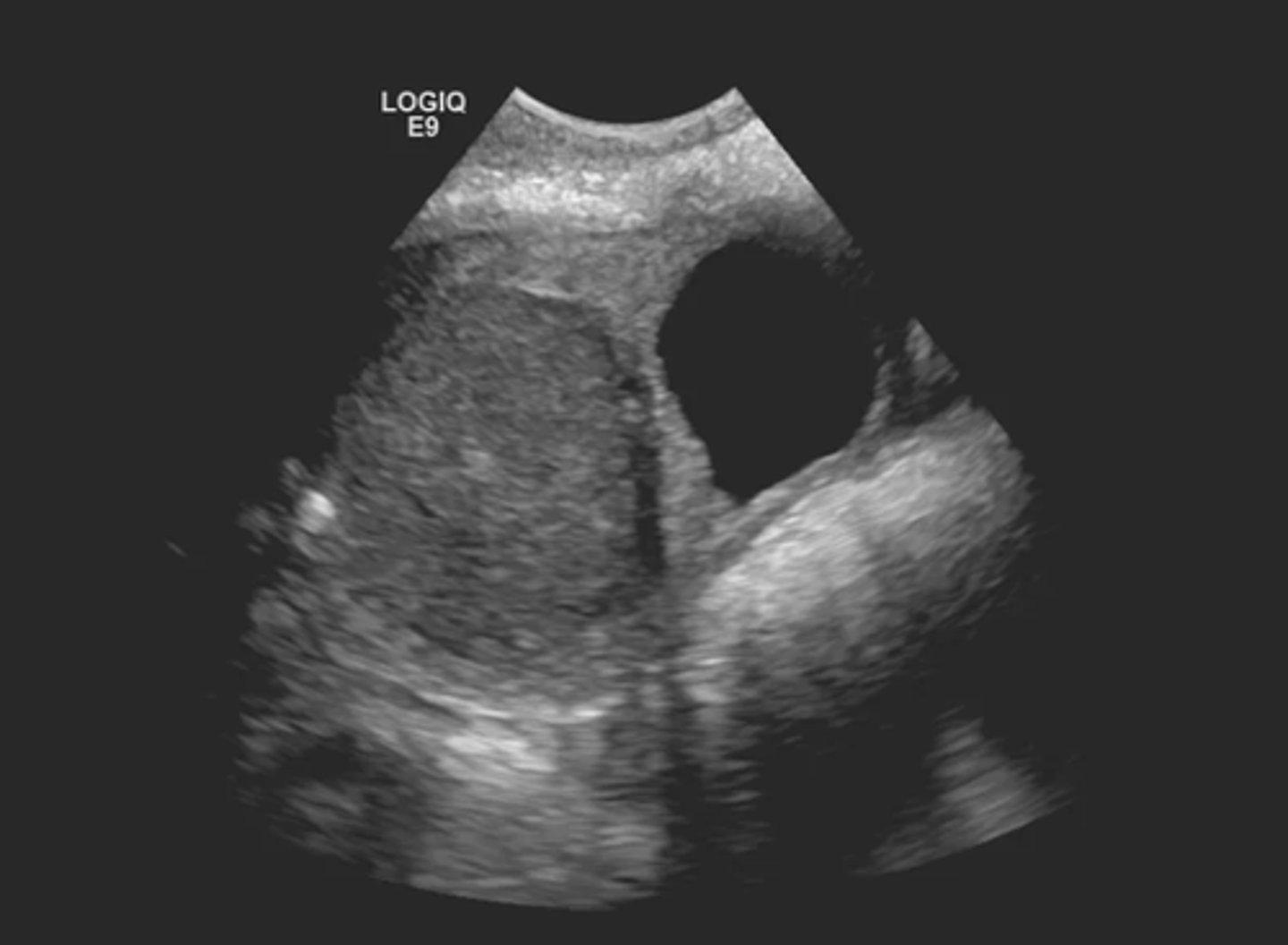 <p>Endometrioma</p><p>-A mass with low level echoes, smooth walls and posterior enhancement indicates an endometrioma or chocolate cyst</p>