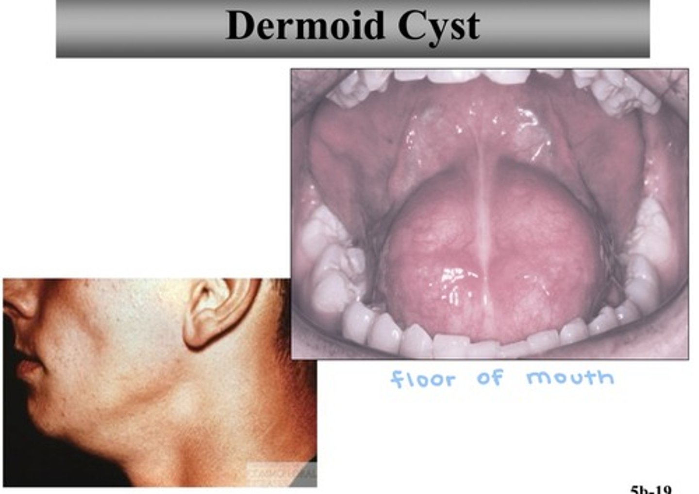 <p>- cause: epithelial remnants during development</p><p>- population: birth or young children</p><p>- clinical features: midline swelling,</p><p>dough-like consistency</p><p>- radiographic features: none</p>