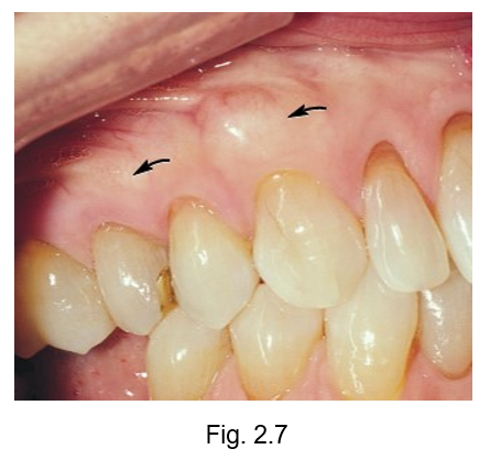 <ul><li><p>facial surface of the alveolar process of maxillary arch may contain ___</p></li><li><p>they are extra localized developmental growths of bone covered in oral mucosa with a possible hereditary etiology and which may be associated with occlusal trauma </p></li></ul><p></p>