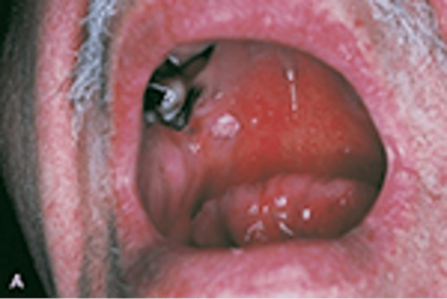 <p>-papilloma at the junction of the hard and soft palate shows a cauliflower like appearance and rough surface from fingerlike projections</p><p>-benign tumor of squamous epithelium that arise as a small, exophytic, pedunculated or sessile growth</p><p>-other oral lesions may resemble a papilloma clincily are verruca vulgaris (common wart)</p>