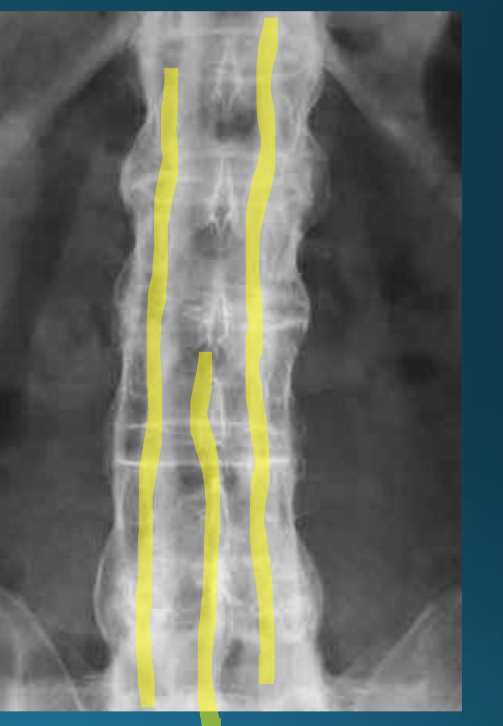 <p>what do you call this sign? what diangosis is this apart of? </p>