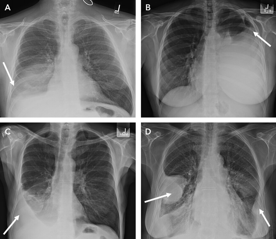 <p>Chest x-ray.</p><p>Ultrasound, particularly in semirecumbent/supine patient's.</p><p>Pleural fluid of unknown cause greater than <strong>1 cm</strong></p>