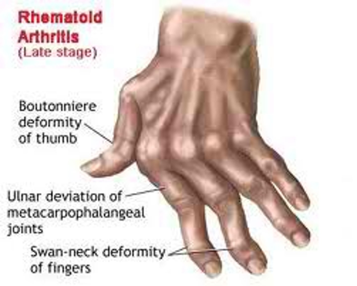 <p>Description: Chronic-inflammatory-autoimmune disease- idiopathic</p><p>Signs and Symptoms: joint tenderness, anemia, osteoporosis, muscle atrophy, and</p><p>cardiovascular problems</p><p>Coursefrom handout:*</p><p>1. exacerbations and remissions</p><p>2. RA begins with synovitis of the affected joint</p><p>3. Inflammatory blood cells migrate to the joint, causing swelling</p><p>4. Inflamed synovial membrane thickens into a pannus</p><p>5. Pannus erodes cartilage, scar tissue forms, articulating bone ends connect</p><p>6. The end result, ankylosis, produces bent, deformed fingers</p><p>Treatmentsfrom handout:*</p><p>-Conservative therapy</p><p>-Progressive treatment</p><p>-Embrel</p>