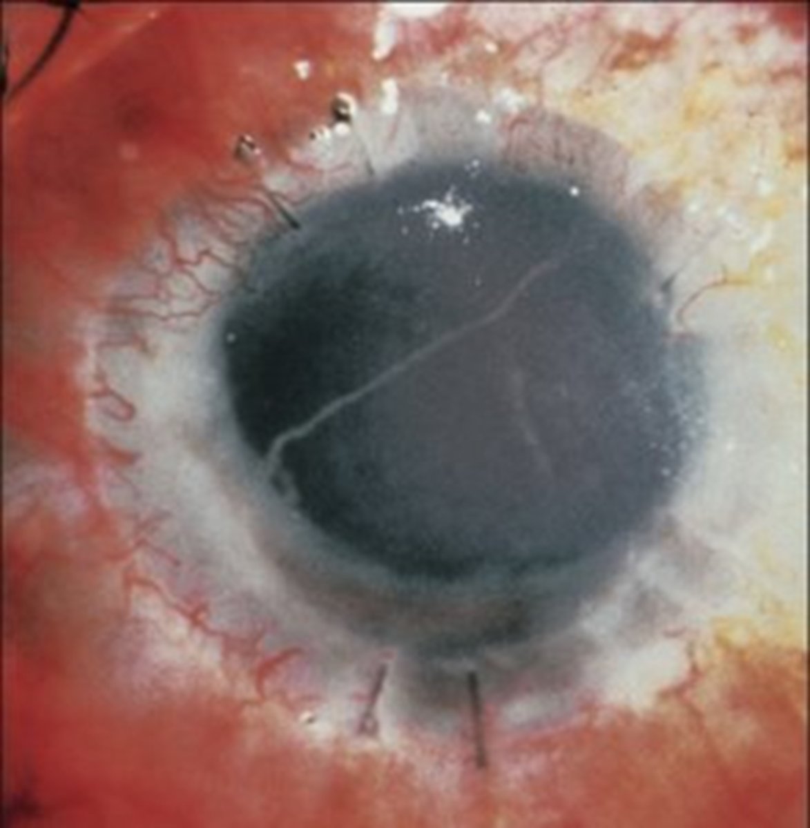 <p>While topical steroids are the mainstay tx for graft rejection in PKP, what are 2 other options for tx?</p>