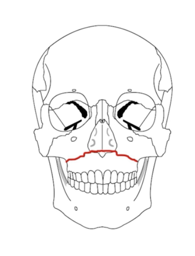 <p>Transverse fracture separating the maxilla from the pterygoid plate and nasal septum.</p><p></p><p>(palate is mobile) </p>
