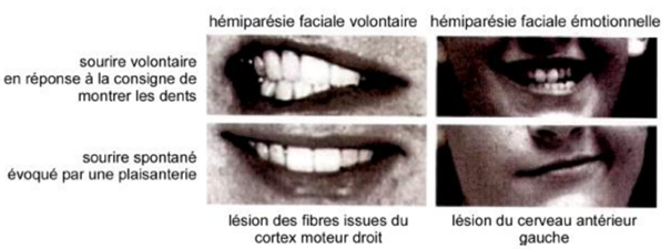 on peut avoir des atteintes dissociées :
-soit on trouve des lésions des projections du cortex moteur primaire = paralysie faciale volontaire avec une préservation relative de la motricité émotionnelle 
-soit on trouve une lésion de la voie extrapyramidale = paralysie émotionnelle avec une préservation de la motricité volontaire