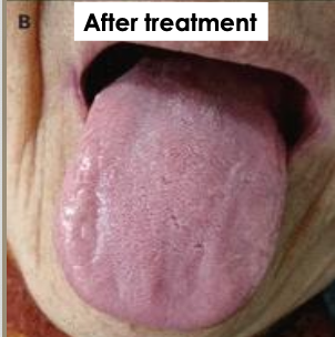 <p>What is the management of anemia?</p>