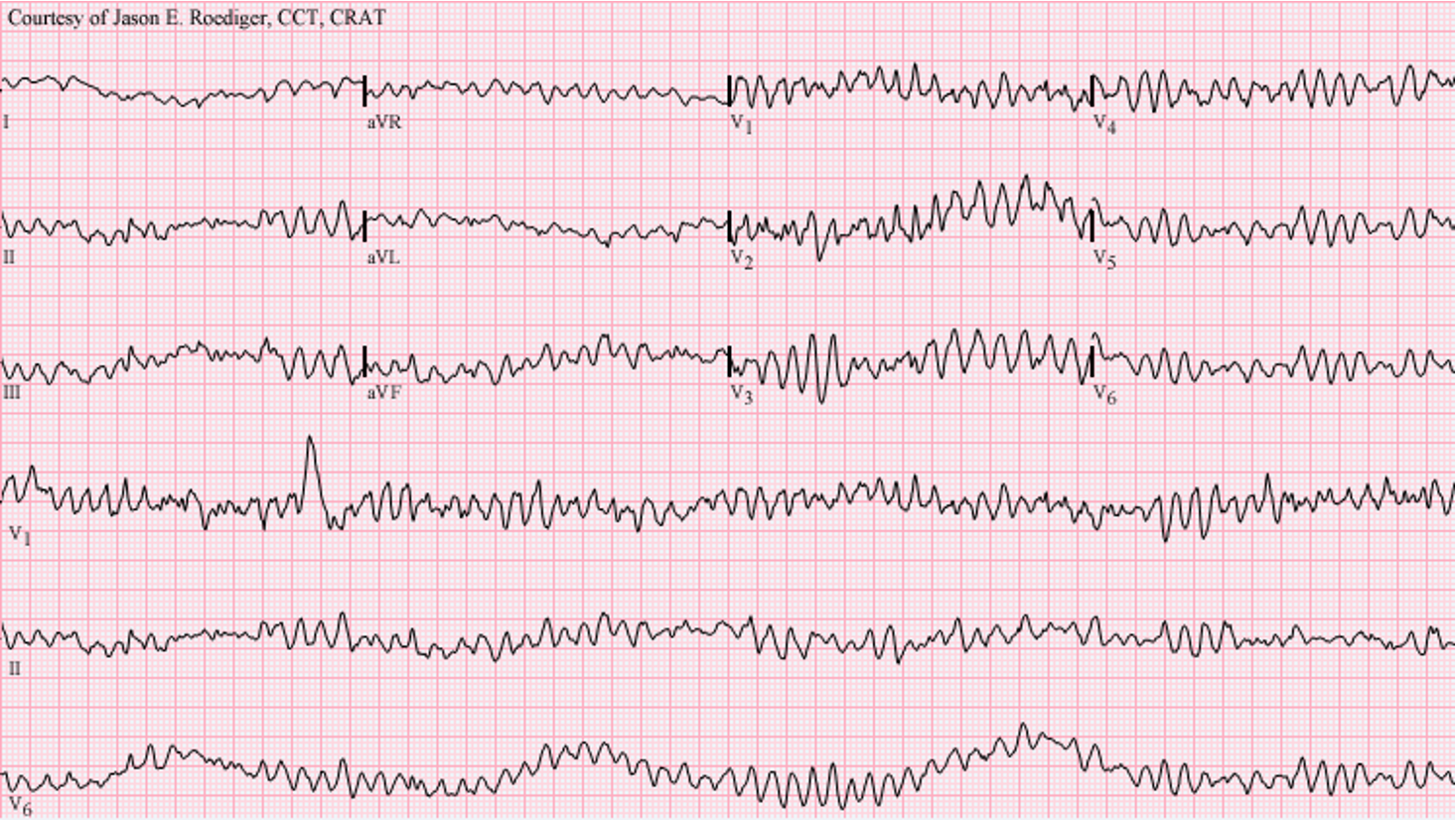 <p>What does this refer to “Chaotic, irregular waveform with no organized QRS”</p>