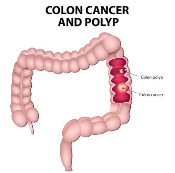 <p><span style="font-family: Droid Sans Mono, monospace">COLORECTAL CANCER</span></p>