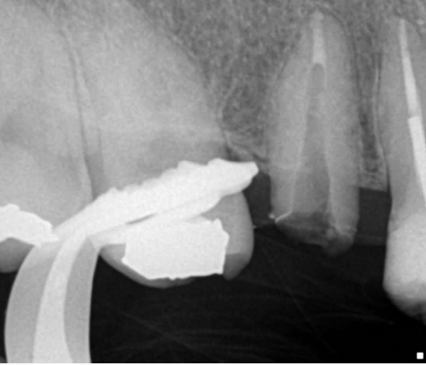 <p>If you do not have much coronal tooth structure, you should use</p><ul><li><p>Cast custom posts</p></li><li><p>Prefabricated posts</p></li></ul><p></p>