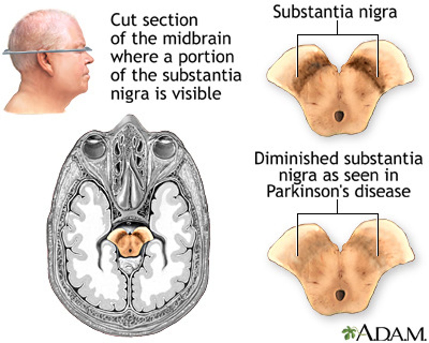 <p>(C) I and II only</p><p>The substantia nigra is noticeably less dark in patients with Parkinson's Disease, and the dopaminergic neurons are affected.</p>