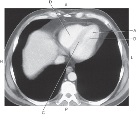 <p>In the figure below of an axial CT of the heart, which line points to the<mark data-color="red"> right ventricle</mark>?</p>