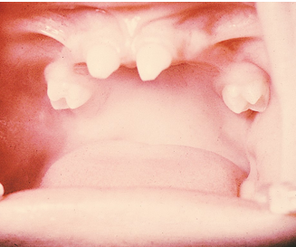 <ul><li><p>no</p></li><li><p>absence of some or all teeth in each dentition</p></li></ul><p></p>
