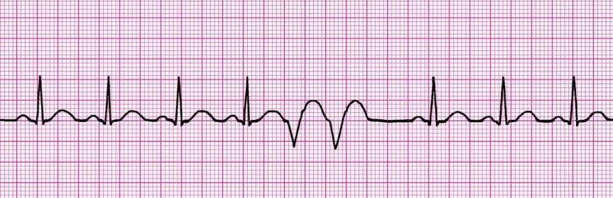 <p>Two consecutive premature beats </p>