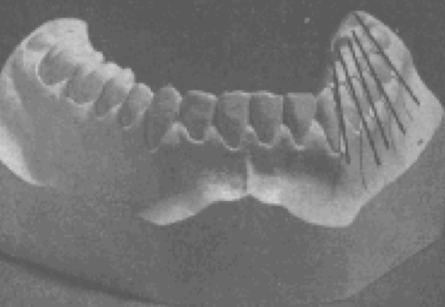 <p>progressively greater “minus” crown inclination existed from the lower canines through the lower second molars</p>