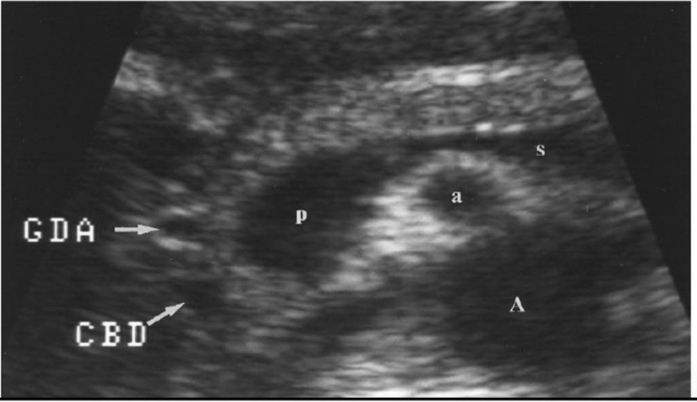 <p>Gastroduodenal artery (GDA) &amp; Common Bile Duct (CBD)</p>