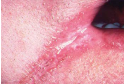 <p>Name the candidiasis associated lesion</p>