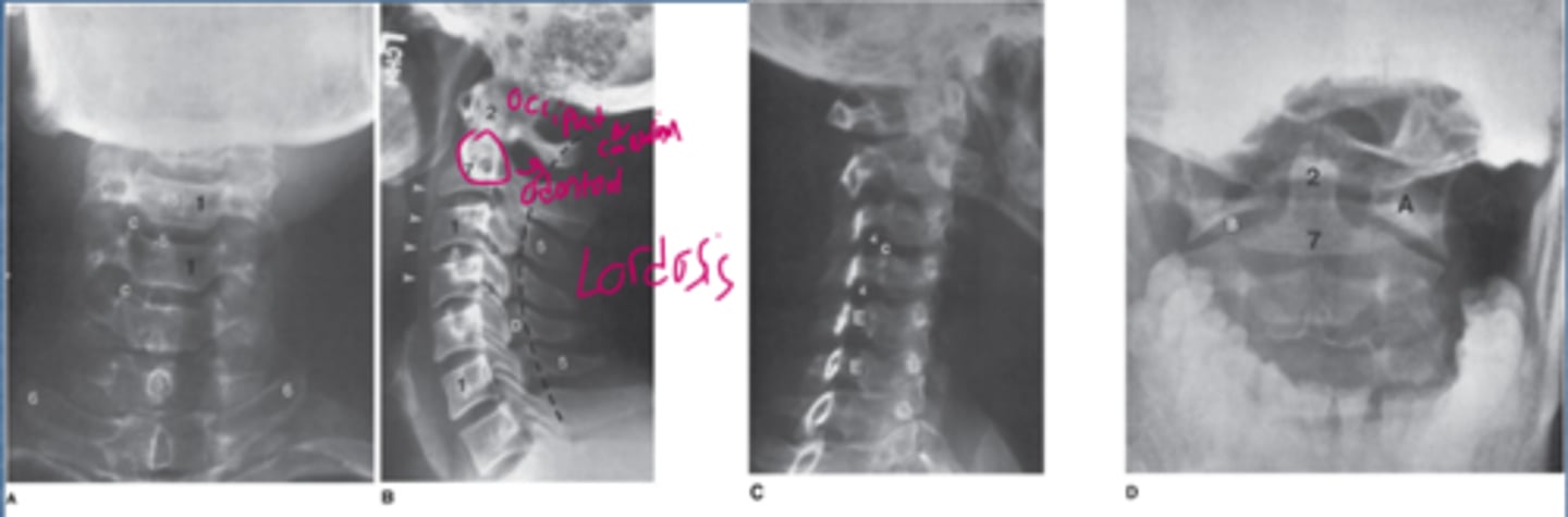 <p>1=vertebral body</p><p>2=odontoid process (dens)</p><p>3=articular facet joint</p><p>4=intervertebral foramen</p><p>5=spinous process</p><p>6=transverse process</p><p>7=body of axis</p><p>8=interverbal disk space</p><p>9=anterior arch of atlas</p><p>A=lateral mass of atlas</p><p>B=atlantoaxial joint</p><p>C=uncinate process</p><p>D=lamina</p><p>E=pedicle</p>